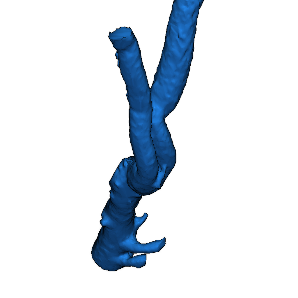 3D модель аортального бифуркационного сегмента
