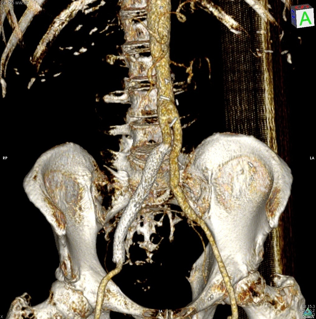3D модель аортального бифуркационного сегмента
